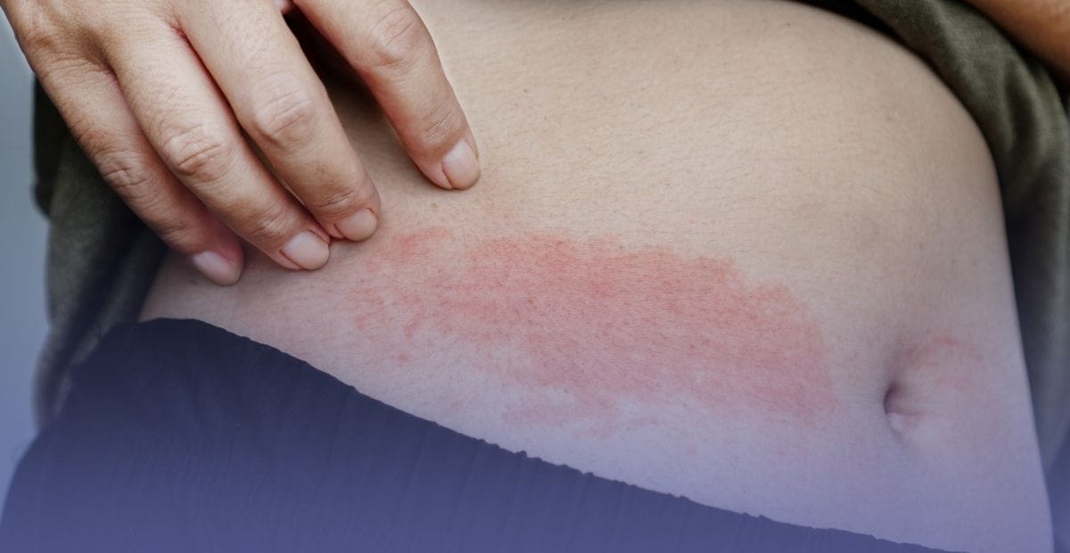Close-up view of a person checking an inflamed, reddish skin rash on the abdomen.